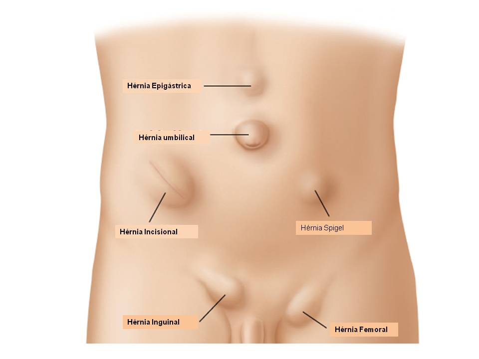Hérnia1