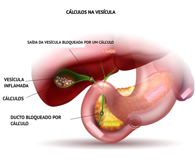VESÍCULA - PEDRA NA VESÍCULA - Dra. Andréa Furlan
