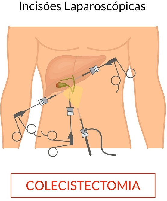 Polipo de Vesicula 2
